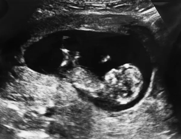 Ultraschall des Fötus 3 Monate im Mutterleib lizenzfreie Stockbilder