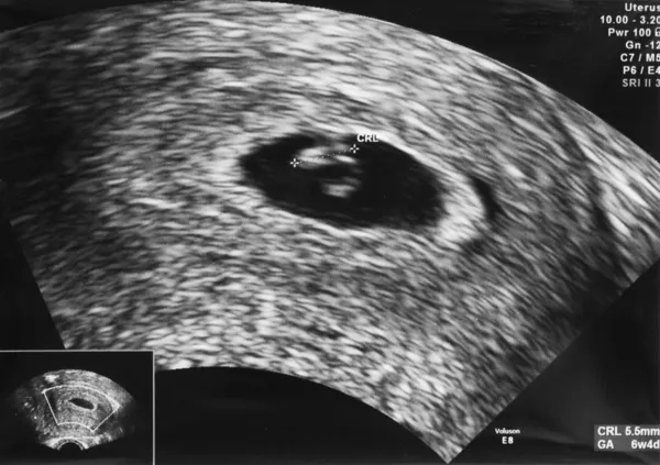 Imagen ultrasónica de un embrión a la edad de 6 semanas y 4 días Imágenes de stock libres de derechos