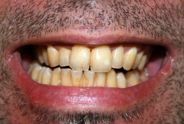 Žluté zuby — Stock fotografie