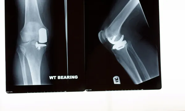 Una radiografia di una sostituzione parziale del ginocchio — Foto Stock