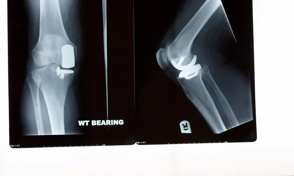 Radiografía de un reemplazo parcial de rodilla Fotos de stock libres de derechos