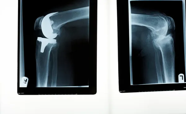 Eine Röntgenaufnahme eines Kniegelenks — Stockfoto