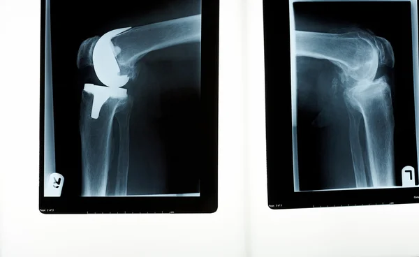 Radiografía de un reemplazo de rodilla Imagen de stock