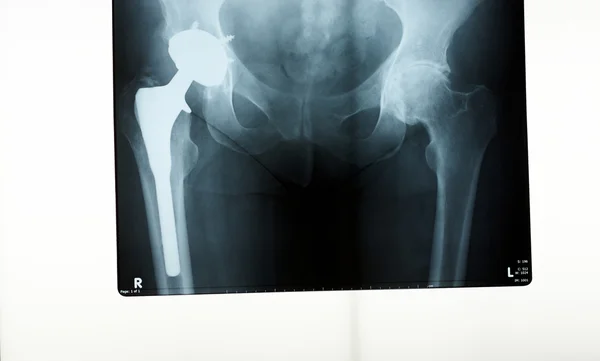 Radiografía de un reemplazo de cadera Imagen de stock