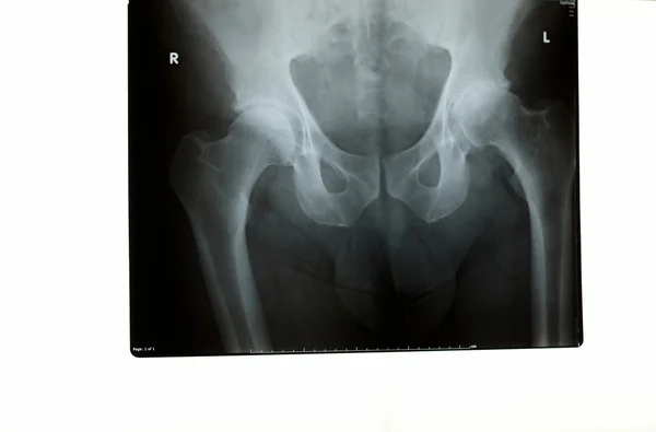 Una radiografía de cadera — Foto de Stock