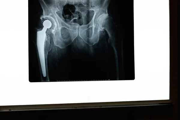 Hip x-ray — Stock Photo, Image