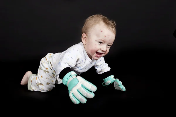 Baby with chickenpox — Stock Photo, Image