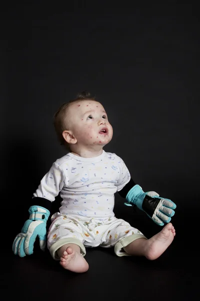 Bambino con varicella — Foto Stock