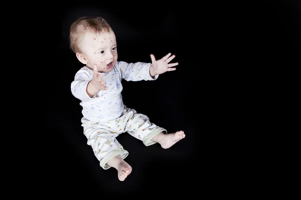 婴儿水痘 — 图库照片