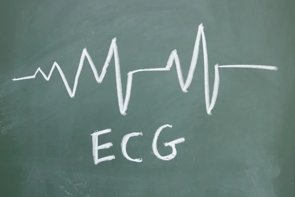 Ecg-Schild mit Kreide auf Tafel gezeichnet — Stockfoto