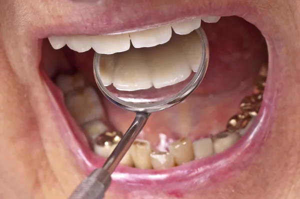 Teeth examination — Stock Photo, Image