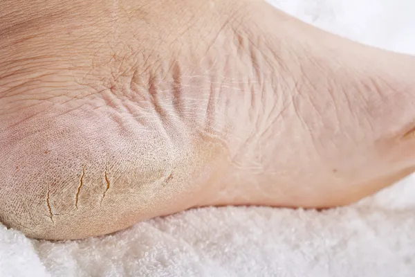 Fötter som behöver en pedikyr — Stockfoto