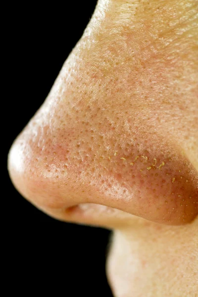 Poros de nariz grasosa — Foto de Stock