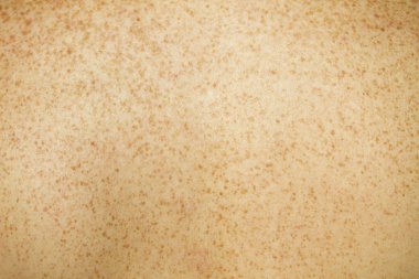 Freckled Back Skin clipart