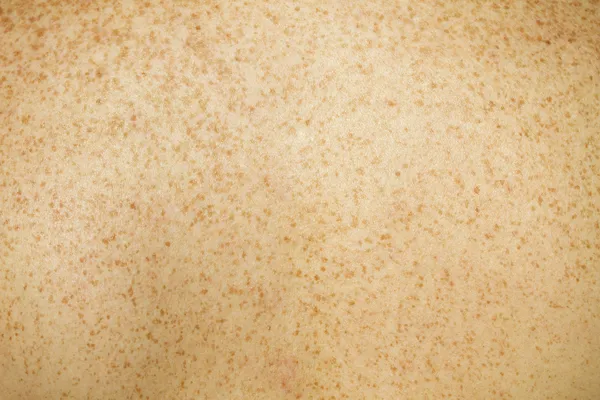 Freckled Back Skin — Stock Photo, Image