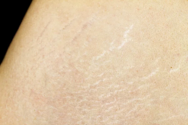 Μέση stretchmarks δέρμα — Φωτογραφία Αρχείου