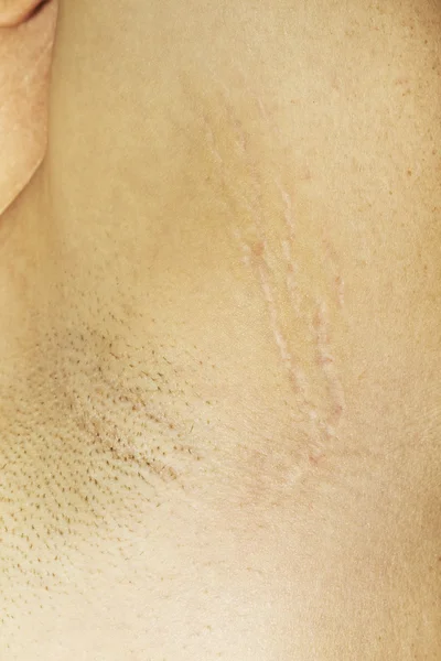 皮膚 stretchmarks 脇の下 — ストック写真