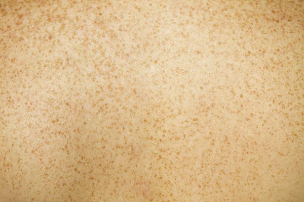 Freckled terug huid Stockfoto