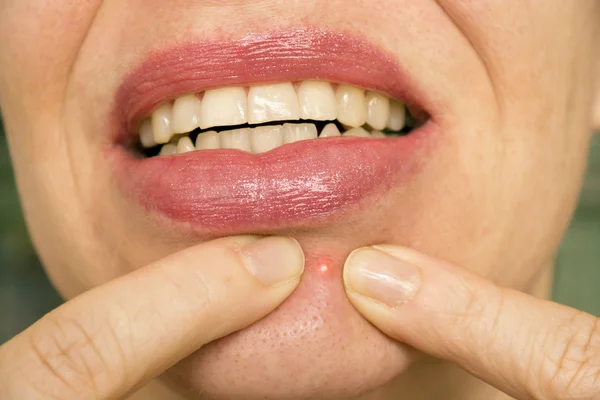 Pimple On Female Face — Stock Photo, Image