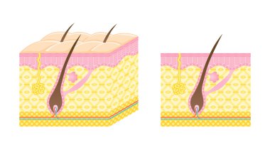 Hair follicle clipart