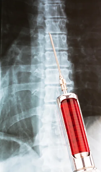 Hypodermic needle and syringe with x-ray — Stock Photo, Image