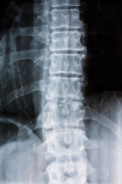 X-ray image of a spine clipart