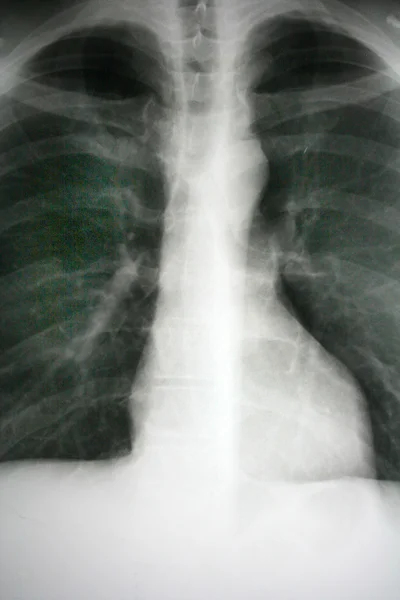 X-ray foto — Stockfoto