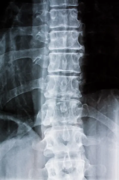 Röntgenfoto van een wervelkolom — Stockfoto