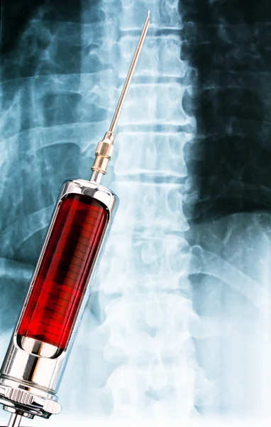 Nadel und Spritze mit Röntgenbild — Stockfoto