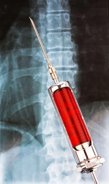 Needle and syringe with radiographic — Stock Photo, Image