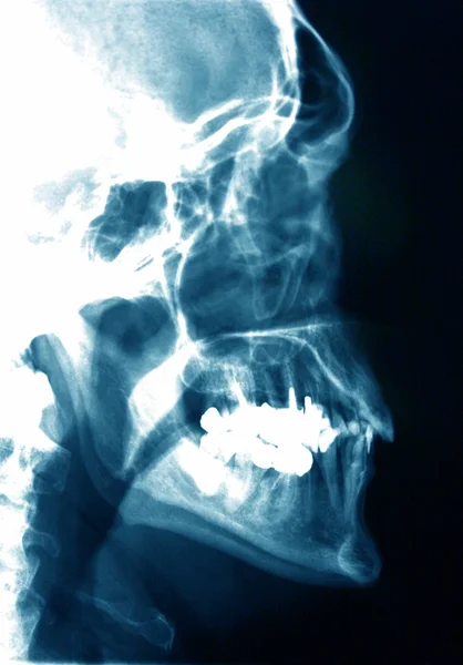 X-ray foto van een hoofd — Stockfoto