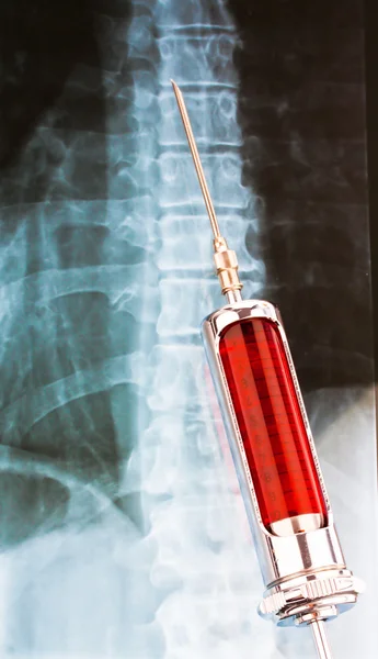 Needle and syringe with rãƒâ ¶ ntgenbild — Stock Photo, Image