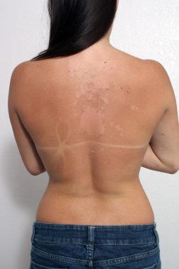 Sunburned, Peeling Female (1) clipart