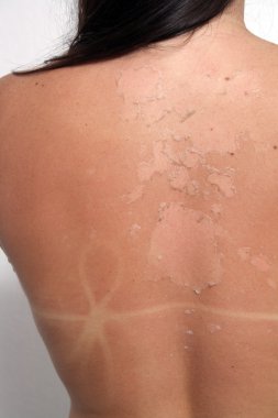 Sunburned, Peeling Female (2) clipart