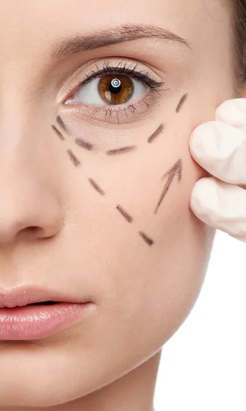 Correctieregels op vrouw gezicht, voordat chirurgie operetion — Stockfoto