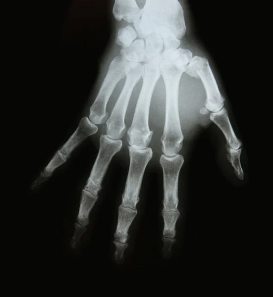 手臂的骨头的 x 射线图像 — 图库照片