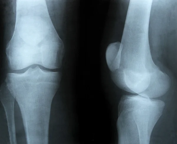 Imagen de rayos X de huesos — Foto de Stock