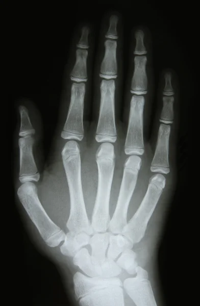 Immagine a raggi X delle ossa del braccio — Foto Stock