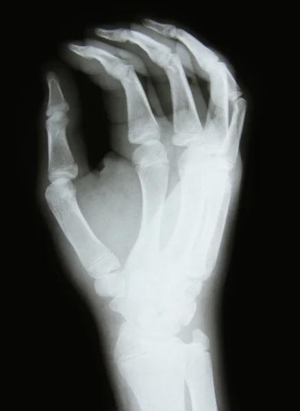 手臂的骨头的 x 射线图像 — 图库照片