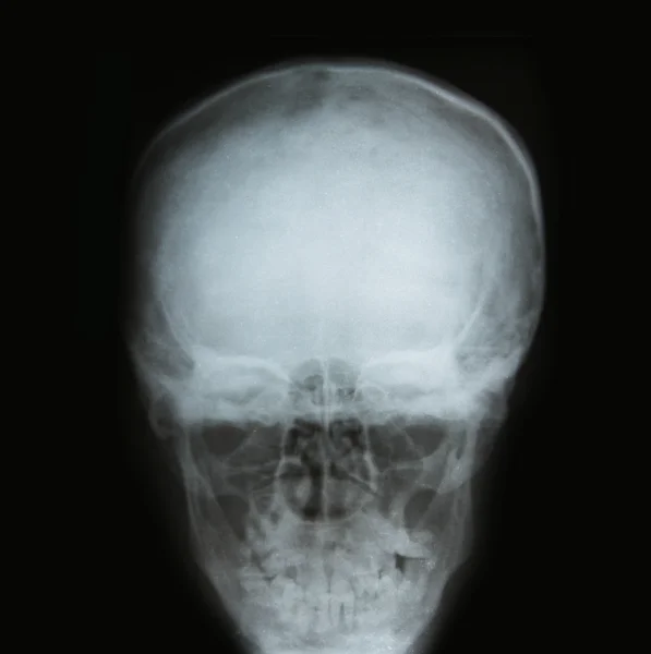 Röntgenbilden av skallen — Stockfoto