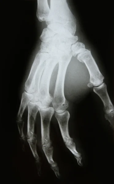 팔의 뼈의 x 선 이미지 — 스톡 사진
