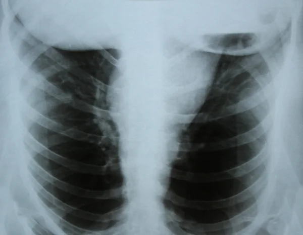 Рентгеновское изображение костей — стоковое фото