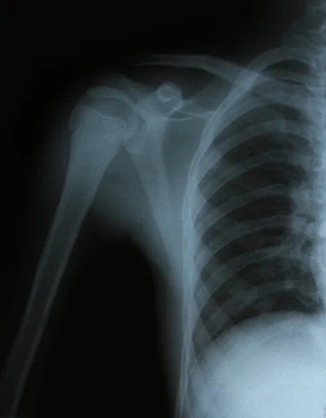骨头的 x 射线图像 — 图库照片