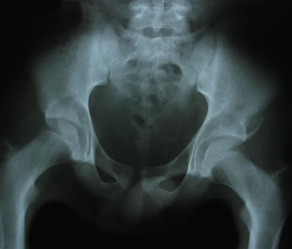 骨头的 x 射线图像 — 图库照片