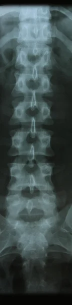 Рентгенівське зображення кісток хребта — стокове фото