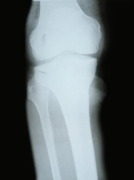 Immagine a raggi X delle ossa — Foto Stock