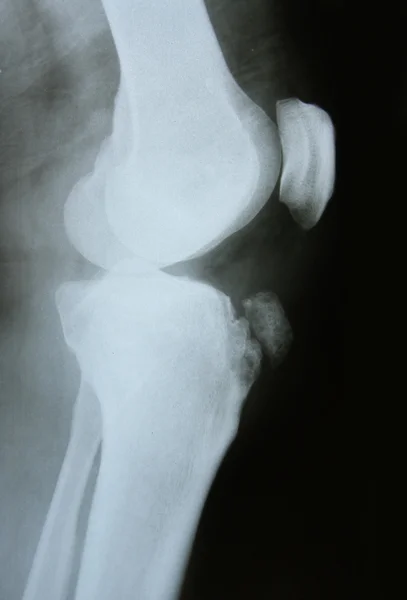 腿部骨骼的 x 射线图像 — 图库照片
