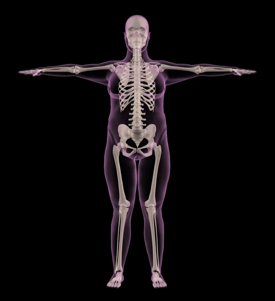 Orvosi csontváz egy túlsúlyos nő — Stock Fotó