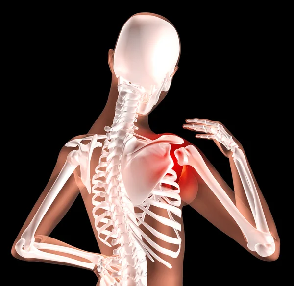 Vrouwelijke skelet met pijn in de schouder — Stockfoto