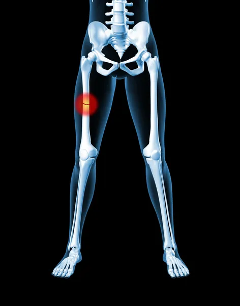 Esqueleto femenino con hueso roto de la pierna — Foto de Stock